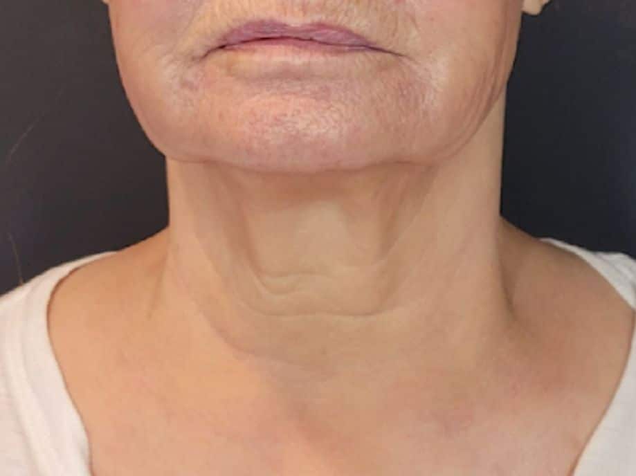 Close-up of a woman's lower face and neck showing sagging skin, neck bands, and wrinkles