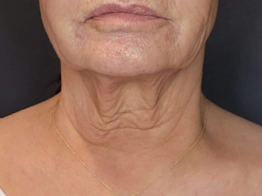 Close-up of an older woman's lower face and neck showing sagging skin, vertical and horizontal neck wrinkles, gold necklace.