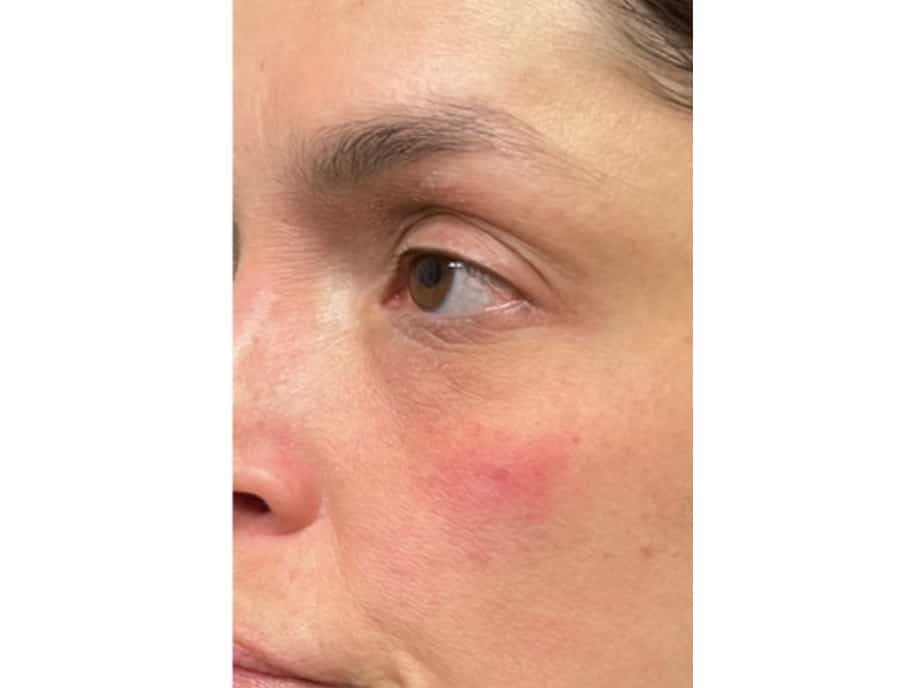Close-up of a woman's face showing a brown eye and a red irritated patch on her cheek.